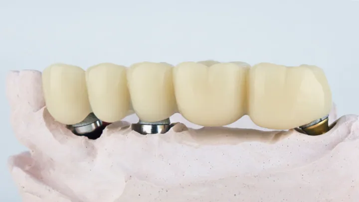 Implant supported bridges