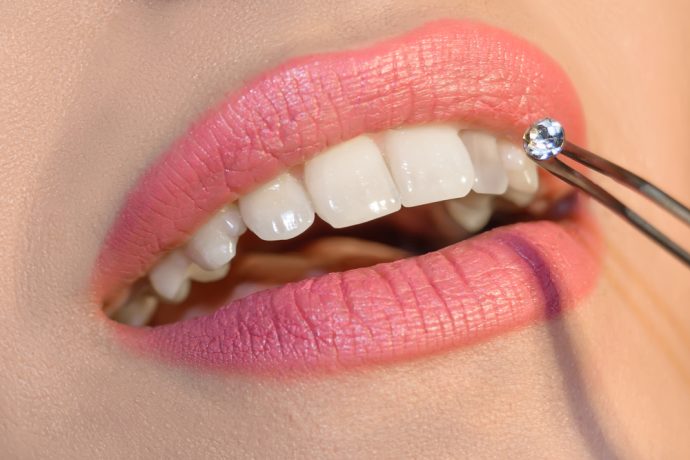 Close-up of a tooth gem applied to a patient's tooth