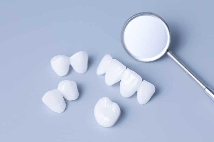 Dental veneers displayed beside a dental mirror